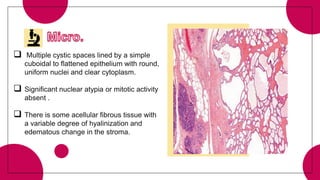  Multiple cystic spaces lined by a simple
cuboidal to flattened epithelium with round,
uniform nuclei and clear cytoplasm.
 Significant nuclear atypia or mitotic activity
absent .
 There is some acellular fibrous tissue with
a variable degree of hyalinization and
edematous change in the stroma.
 
