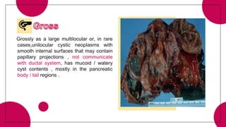 Grossly as a large multilocular or, in rare
cases,unilocular cystic neoplasms with
smooth internal surfaces that may contain
papillary projections , not communicate
with ductal system, has mucoid / watery
cyst contents , mostly in the pancreatic
body / tail regions .
 