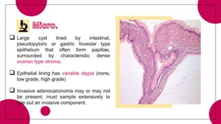  Large cyst lined by intestinal,
pseudopyloric or gastric foveolar type
epithelium that often form papillae,
surrounded by characteristic dense
ovarian type stroma.
 Epithelial lining has variable atypia (none,
low grade, high grade)
 Invasive adenocarcinoma may or may not
be present; must sample extensively to
rule out an invasive component.
 