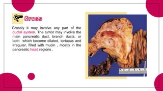 Grossly it may involve any part of the
ductal system. The tumor may involve the
main pancreatic duct, branch ducts, or
both which become dilated, tortuous and
irregular, filled with mucin , mostly in the
pancreatic head regions .
 
