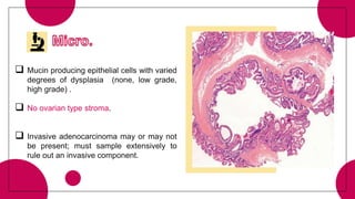  Mucin producing epithelial cells with varied
degrees of dysplasia (none, low grade,
high grade) .
 No ovarian type stroma.
 Invasive adenocarcinoma may or may not
be present; must sample extensively to
rule out an invasive component.
 