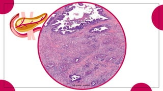 high grade + invasive
 