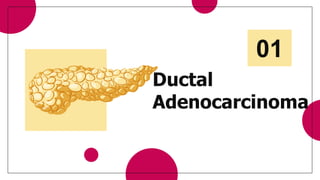 Ductal
Adenocarcinoma
01
 