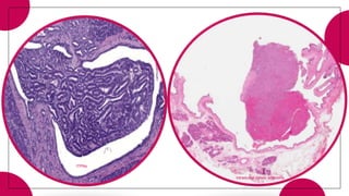 ITPNs
Intraductal pyloric adenoma
 