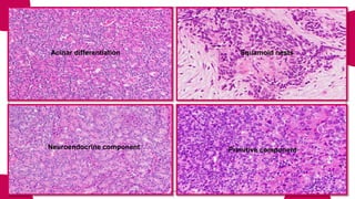 Acinar differentiation Squamoid nests
Neuroendocrine component Primitive component
 