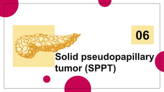 Solid pseudopapillary
tumor (SPPT)
06
 