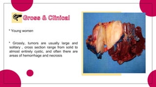 * Young women
* Grossly, tumors are usually large and
solitary , cross section range from solid to
almost entirely cystic, and often there are
areas of hemorrhage and necrosis
 