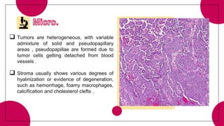  Tumors are heterogeneous, with variable
admixture of solid and pseudopapillary
areas , pseudopapillae are formed due to
tumor cells getting detached from blood
vessels .
 Stroma usually shows various degrees of
hyalinization or evidence of degeneration,
such as hemorrhage, foamy macrophages,
calcification and cholesterol clefts .
 