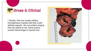 * Grossly, they are usually solitary,
homogeneous masses that lack a well-
defined capsule , the cut surface ranging
from tan yellow to red. Some tumors
contain hemorrhage or necrotic foci .
 