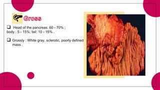  Head of the pancreas: 60 - 70% ;
body : 5 - 15%; tail: 10 - 15% .
 Grossly : White gray, sclerotic, poorly defined
mass .
 
