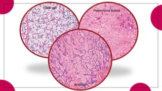 Clear cell
Psammoma bodies
Amyloid
 