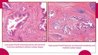 Low-grade PanIN characterized by tall columnar
mucinous epithelium without nuclear atypia
High-grade PanIN features architectural complexity and
marked nuclear atypia
 