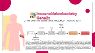  The tumor cells express MUC1, MUC3, MUC4 , MUC5AC & p53
 