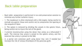 Pancreatic transplant.dr quiyum | PPTX