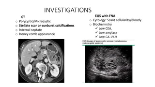 INVESTIGATIONS
EUS with FNA
o Cytology: Scant cellularity/Bloody
o Biochemistry
 Low CEA.
 Low amylase
 Low CA 19-9
CT
o Polycystic/Microcystic
o Stellate scar or sunburst calcifications
o Internal septate
o Honey comb appearance
 