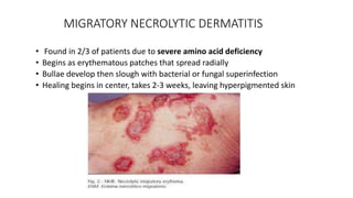 MIGRATORY NECROLYTIC DERMATITIS
• Found in 2/3 of patients due to severe amino acid deficiency
• Begins as erythematous patches that spread radially
• Bullae develop then slough with bacterial or fungal superinfection
• Healing begins in center, takes 2-3 weeks, leaving hyperpigmented skin
 