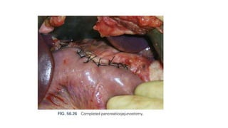 Pancreatic tumors.pptx