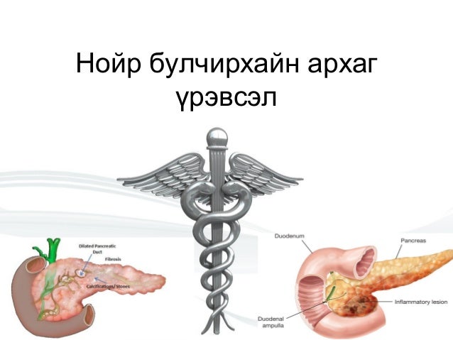 Нойр булчирхайн архаг үрэвсэл