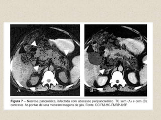 Preditores clínicos de Doença SeveraPancreatite grave = Complicações, Cuidados intensivos, Decisão terapêutica e Prognóstico!Lipase e AmilaseExperiência médica, sinais de falência orgânica e testes laboratoriais ( leucograma e PCR)Escore