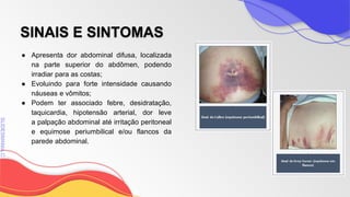 SLIDESMANIA
SLIDESMANIA.C
SINAIS E SINTOMAS
● Apresenta dor abdominal difusa, localizada
na parte superior do abdômen, podendo
irradiar para as costas;
● Evoluindo para forte intensidade causando
náuseas e vômitos;
● Podem ter associado febre, desidratação,
taquicardia, hipotensão arterial, dor leve
a palpação abdominal até irritação peritoneal
e equimose periumbilical e/ou flancos da
parede abdominal.
 
