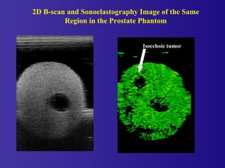 2D B-scan and Sonoelastography Image of the Same
Region in the Prostate Phantom
Isoechoic tumor
 