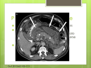 Pancreatitis Necrotizante 
 Se desarrolla en 5-10% de los pacientes 
 Implica al páncreas y los tejidos 
peripancreaticos, poco común que solo 
afecte a los tejidos y menos común verse 
afectado el parénquima. 
 Resultado de la mala perfusión 
Gut 2013;62:102–111 
 