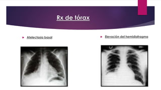 Rx de tórax 
 Atelectasia basal  Elevación del hemidiafragma 
 