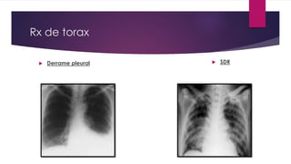 Rx de torax 
 Derrame pleural  SDR 
 