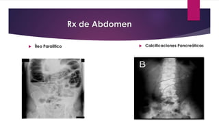 Rx de Abdomen 
 Íleo Paralitico  Calcificaciones Pancreáticas 
 Pancreatitis crónica 
 