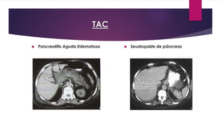 TAC 
 Pancreatitis Aguda Edematosa  Seudoquiste de páncreas 
 