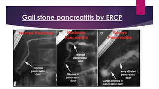 Gall stone pancreatitis by ERCP 
 