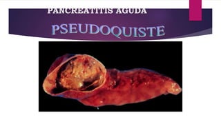 PANCREATITIS AGUDA 
 