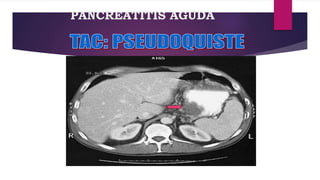 PANCREATITIS AGUDA 
 