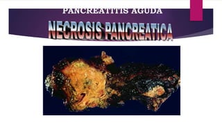PANCREATITIS AGUDA 
 