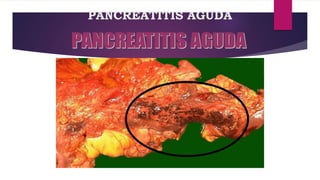 PANCREATITIS AGUDA 
 
