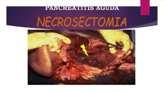 PANCREATITIS AGUDA 
 