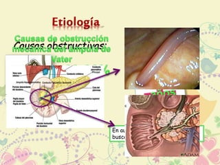 Causas obstructivas: 
En ausencia de litiasis biliar se 
busca Microlitiasis y lodo biliar 
 