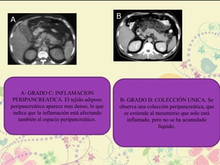 A- GRADO C: INFLAMACION 
PERIPANCREATICA. El tejido adiposo 
peripancreático aparece mas denso, lo que 
indica que la inflamación está afectando 
también al espacio peripancreático. 
B- GRADO D: COLECCIÓN UNICA. Se 
observa una colección peripancreática, que 
se extiende al mesenterio que solo está 
inflamado, pero no se ha acumulado 
líquido. 
 