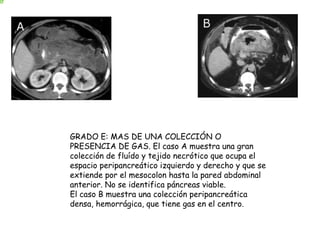 GRADO E: MAS DE UNA COLECCIÓN O 
PRESENCIA DE GAS. El caso A muestra una gran 
colección de fluído y tejido necrótico que ocupa el 
espacio peripancreático izquierdo y derecho y que se 
extiende por el mesocolon hasta la pared abdominal 
anterior. No se identifica páncreas viable. 
El caso B muestra una colección peripancreática 
densa, hemorrágica, que tiene gas en el centro. 
 