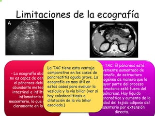 Limitaciones de la ecografía 
- La ecografía abdominal 
no es capaz de demostrar 
el páncreas debido al 
abundante meteorismo 
intestinal e infiltración 
inflamatoria del 
mesenterio, lo que aparece 
claramente en la TAC. 
B- TAC. El páncreas está 
levemente aumentado de 
tamaño, de estructura 
homogénea de manera que la 
mayor parte del proceso 
inflamatorio está fuera del 
páncreas. Hay líquido 
peripancreático y aumento de la 
densidad del tejido adiposo del 
mesenterio por extensión 
directa. 
La TAC tiene esta ventaja 
comparativa en los casos de 
pancreatitis aguda grave. La 
ecografía es mas útil en 
estos casos para evaluar la 
vesícula y la vía biliar (ver si 
hay coledocolitiasis o 
dilatación de la vía biliar 
asociada.) 
 