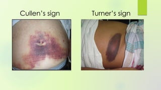 Cullen’s sign Turner’s sign
 