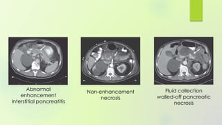 Abnormal
enhancement
Interstitial pancreatitis
Non-enhancement
necrosis
Fluid collection
walled-off pancreatic
necrosis
 