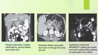 Atrophic pancreas, multiple
calcifications, stones dilated
pancreatic duct
Markedly dilated pancreatic
duct seen in through the body
and tail
Gadolinium-enhanced
MRI/MRCP- dilated pancreatic
duct with multiple filling defects
s/o pancreatic duct calculi.
 