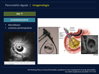 Pancreatitis Aguda | Imagenologia
RM ??
ECOENDOSCOPIA
UK Working Party on Acute Pancreatitis: guidelines for the management of acute pancreatitis.
Gut 2005 (Suplemento III):2005:1111-1119
• Microlitiasis
• Lesiones periampulares
 