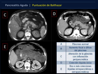 Pancreatitis Aguda | Puntuación de Balthazar
C D
E
 