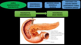 DAÑOS
MACROSCOPICOS
PANCREATICOS
HEMORRAGIA
(ROJO-NEGRO)
NECROSIS GRASA
(AMARILLA
BLANCA)
PERITONEO CON
LIQUIDO SEROSO
LIGERAMENTE TURBIO
Y MARRON (GRASA)
PANCREATITIS
HEMORRAGICA
HEMORRAGIA
(ROJO-NEGRO)
 