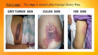 Fox's sign : The sign is named after George Henry Fox.
 