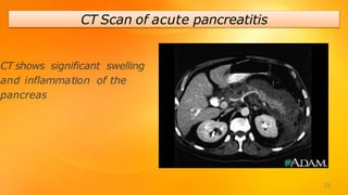 CT Scan of acute pancreatitis
CT shows significant swelling
and inflammation of the
pancreas
29
 