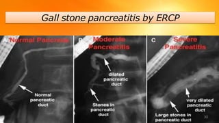 Gall stone pancreatitis by ERCP
30
 