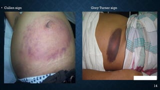 14
• Cullen sign Grey Turner sign
 